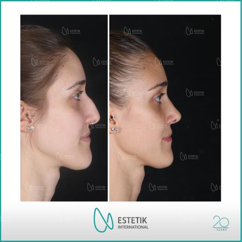 عملية تجميل الأنف صور قبل وبعد